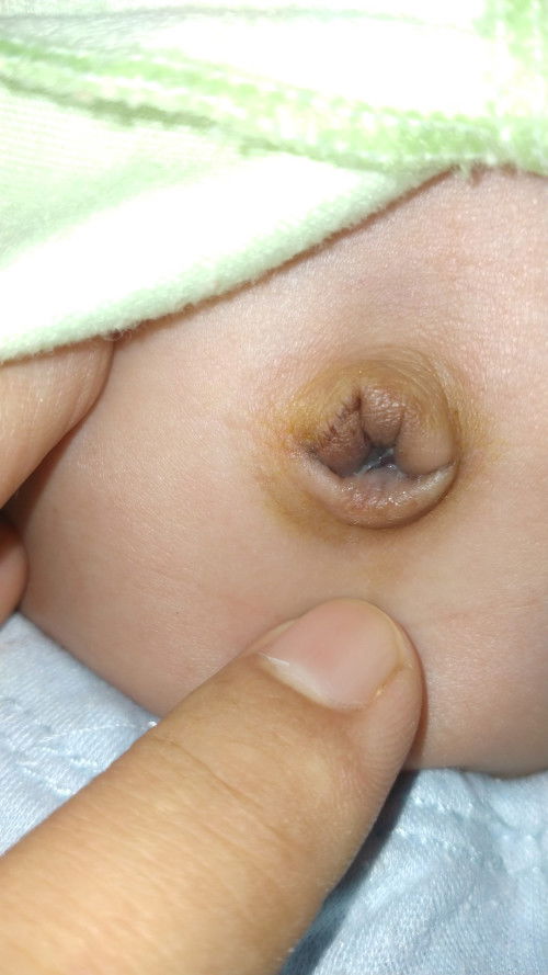 Pusar bayi masih basah umur 1 bln