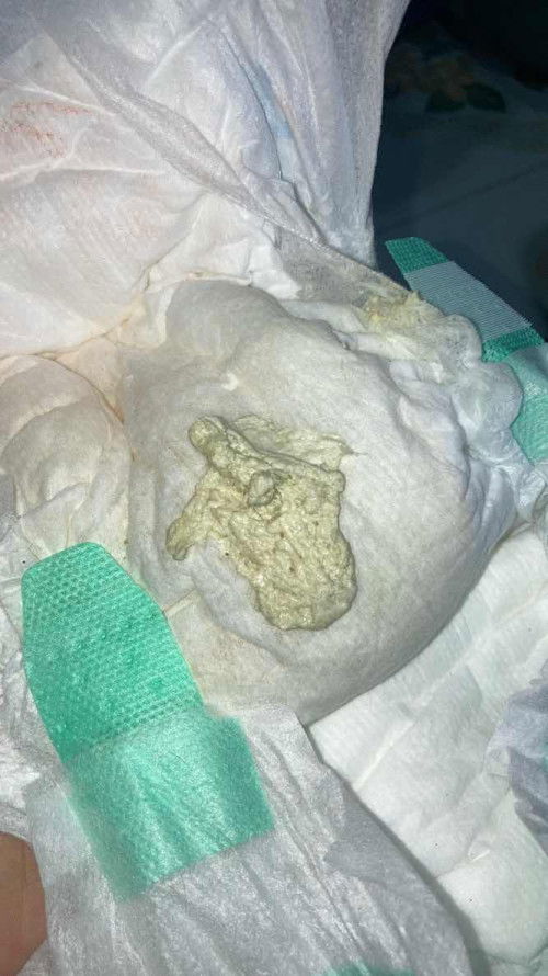 ถ่ายสีซีดแบบนี้ผิดปกติมั้ยคะ