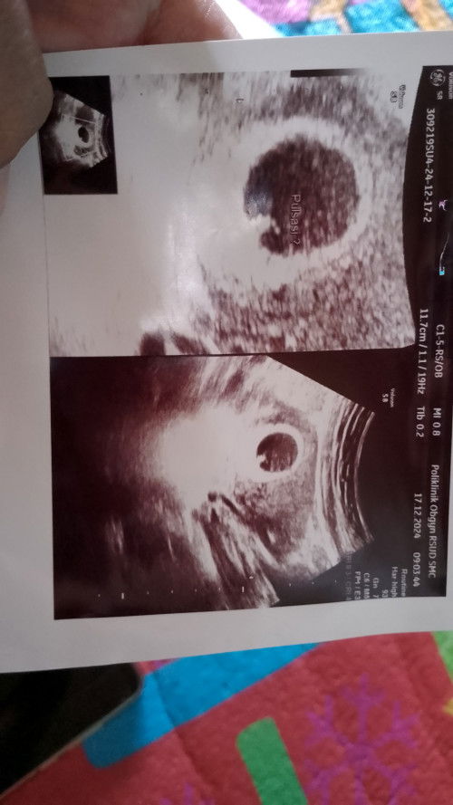 Assalamualaikum bun, tgl 17 Desember kemarin sy usg karna sudah 3x ada flek coklat sedikit