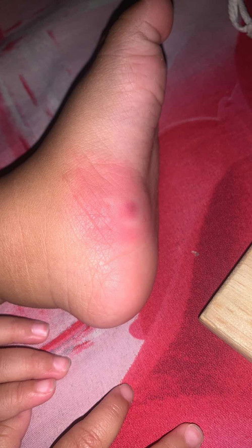 Gigitan seranga atau bukan