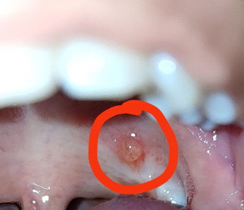 TW// Sariawan, Mulut

hamil 6w (hitungan hpht) tiba2 muncul ada benjolan di langit2 belakang mulut