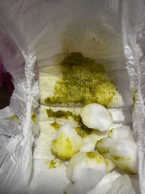 ทารก 23 วัน ถ่ายสีเหลืองปนเมือกมีฟอง