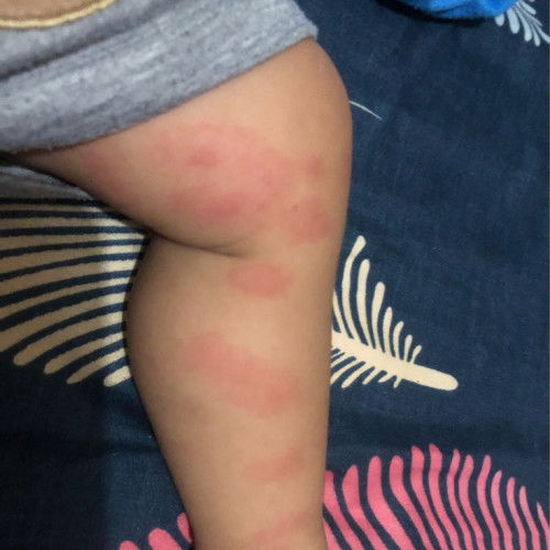 Merah merah di badan bayi