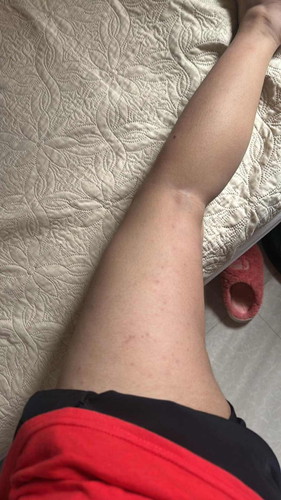 Puppp Rashes