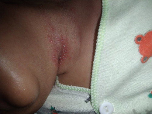 Leher bayi merah merah