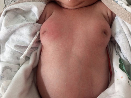 Ada benjolan di payudara bayi