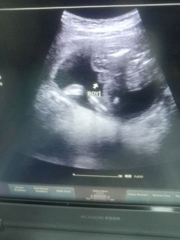 Nagpa ultra sound ako ng 5mos tummy ko confirm kaya na BOY po sya ?