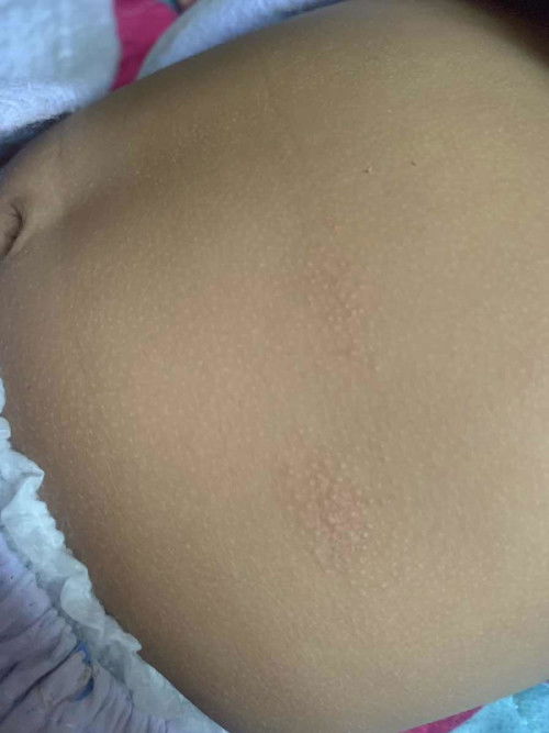 Kulit baby naik tompok spt kulit kering