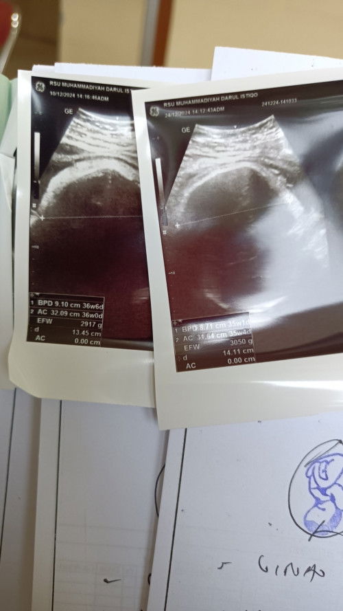 Usia Kehamilan Malah mundur dari sebelumnya