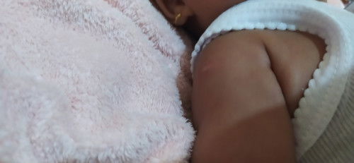 Bekas suntikan bcg buat anak rewel