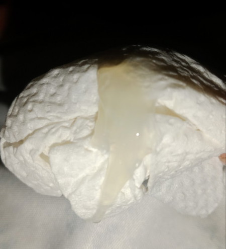 37+6w มีมูกเหนียว ออกเยอะ คือน้ำคล่ำ หรือ ตกขาวหรอคะ 
ท้องปั้นแข็งบ่อยมาก เจ็บท้องน้อยแต่เจ็บทนได้