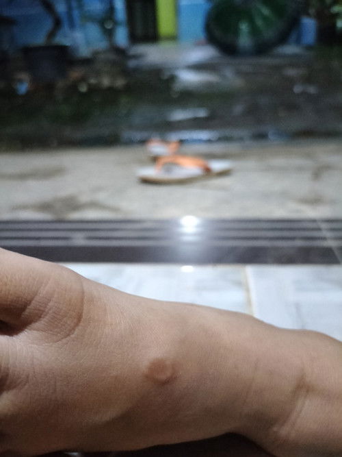 Benjolan di kaki anak