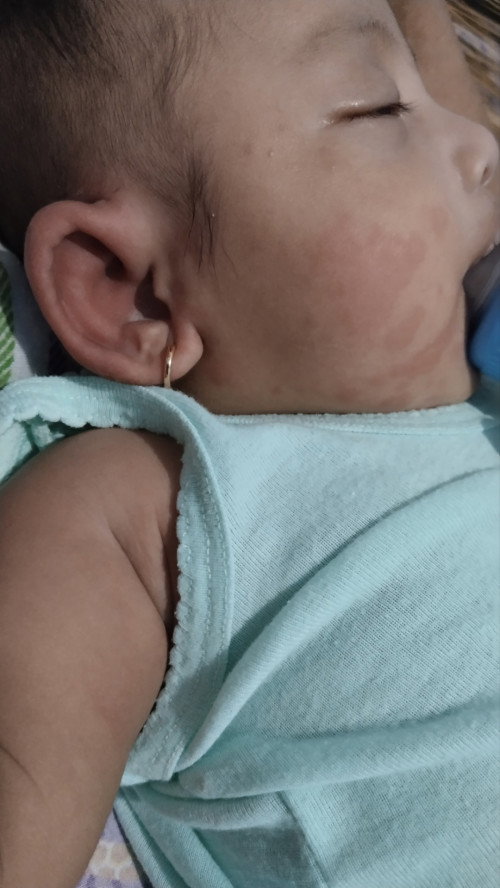 Merah di pipi dan telinga bayi