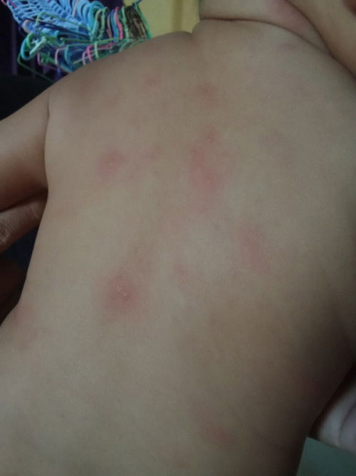 ผื่นตุ่มขึ้นหลังน้อง8เดือนคืออะไรคะ