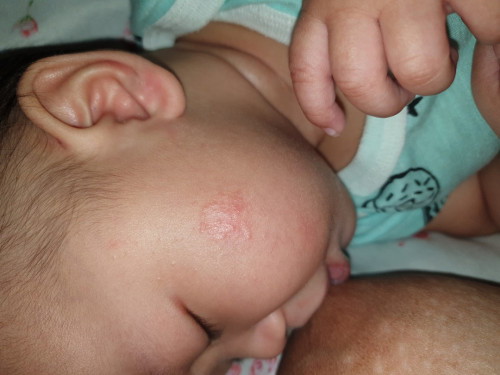 Mga momies Meron din ba ganto mga baby nyo? Or nag karoon naba ng ganto? Worried kasi ako eh.