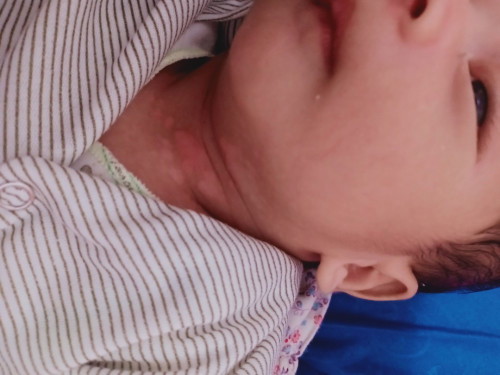 Jamur bayi 1 bulan