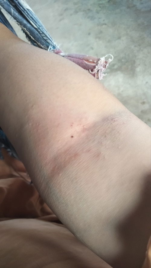 สอบถามแม่ๆหน่อยค่ะท้องได้6เดือนมีผื่นขึ้นแบบนี้เป็นอะไรมั้ยค่ะท้องสองแล้วท้องแรกไม่เป็นค่ะ