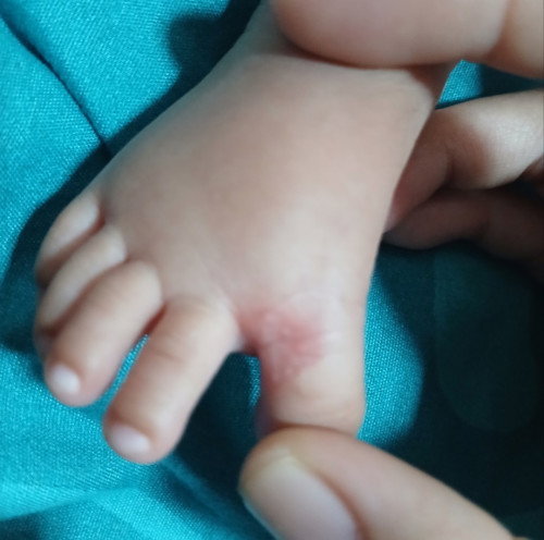 Merah merah pada kulit bayi