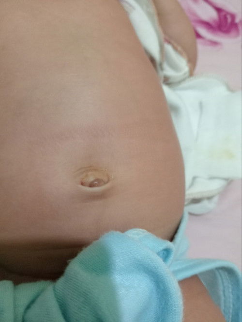 Puser sudah pupa tapi masih basah dan ada benjolan dikit