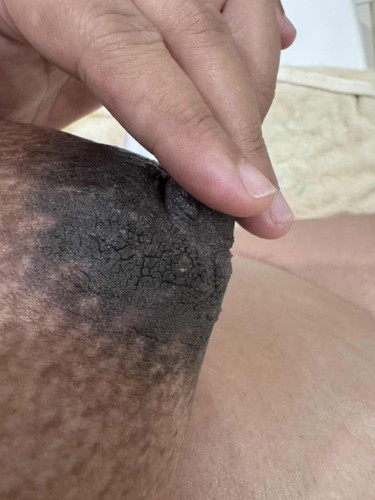 ลานนมแห้งแตก เช็ดแล้วผิวหลุด แม่ๆคนไหนเป็นบ้างคะ มีวิธีแก้อย่างไร 33w