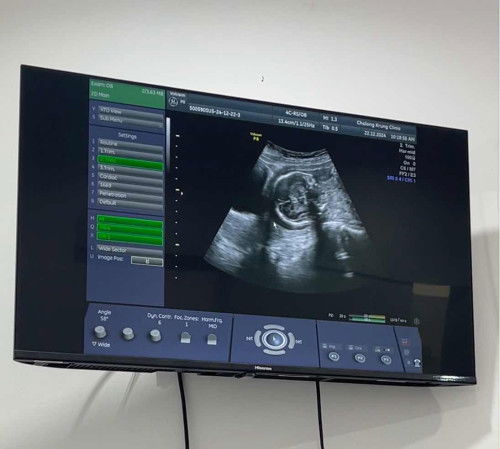 21W น้องเอาหัวลงต่ำ เสี่ยงคลอดก่อนกำหนด ต้องเหน็บยากันแท้ง