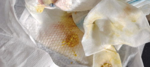 Bakit may kasamang dugo ang popo ni baby