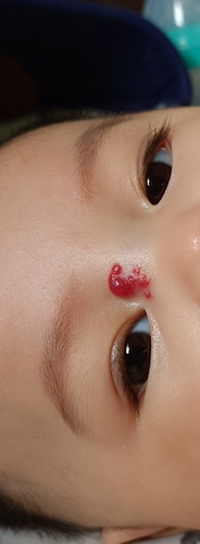 Hemangioma