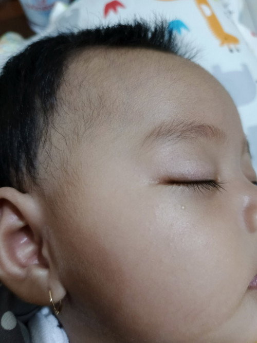 Cara hilangin milia pda kulit bayi, pakai apa ya?