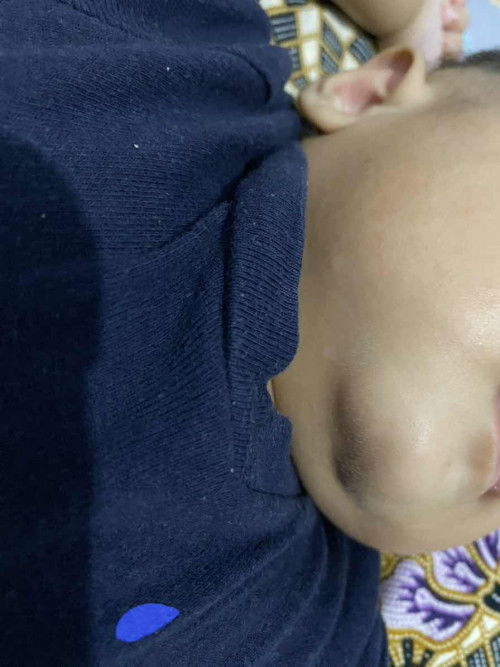 Putih2 di dagu dan dada bayi