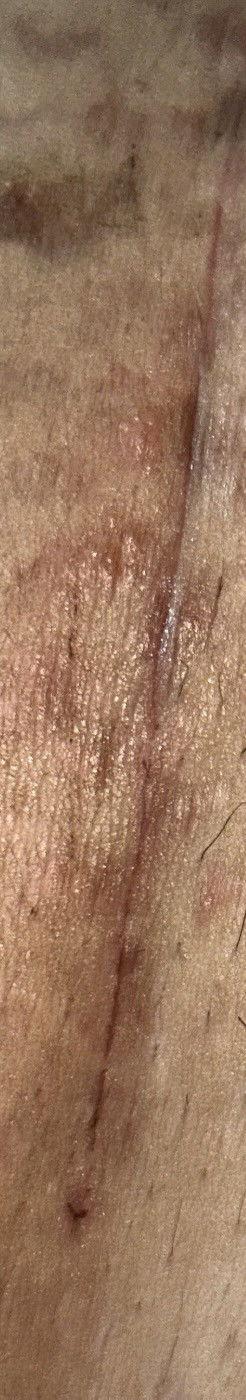 สอบถามแม่ผ่าคลอดค่ะ