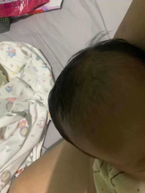 benjolan di kepala bayi