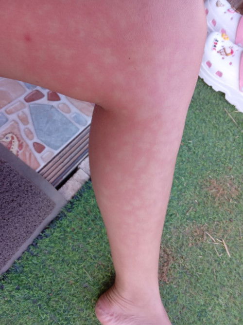 เป็นอะไรไม่รู้ค่ะไม่คันไม่แสบไม่ร้อนไม่นูนขึ้นจากผิวหนัง