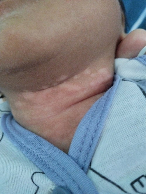 Gatal pada leher bayi