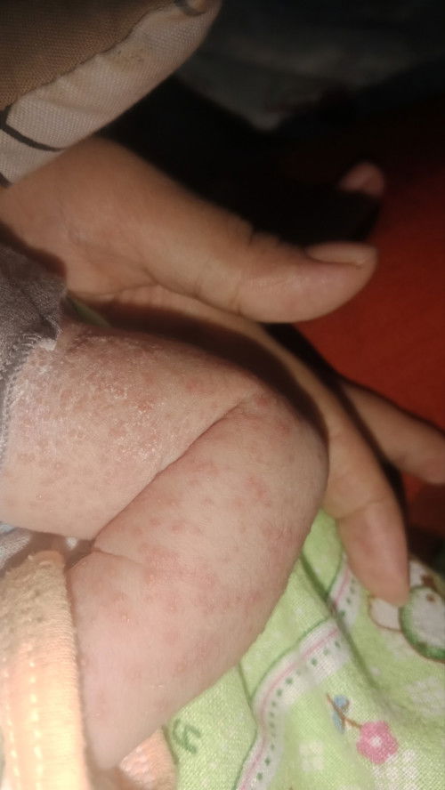 Bintik2 seperti keringat pada bayi