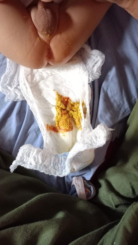 Mau tanya soal pup bayi 4 bulan bun pakai obat apa ya, udh berobat tapi ga cocok