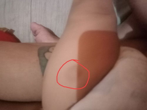 Benjolan bekas suntikan imunisasi