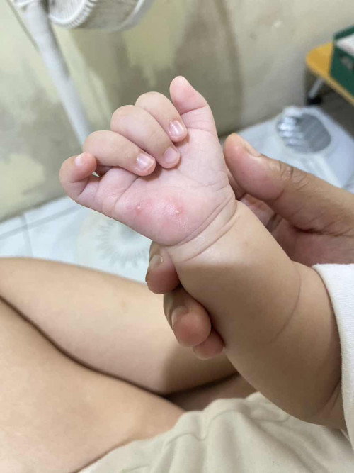 bintik di telapak tangan bayi