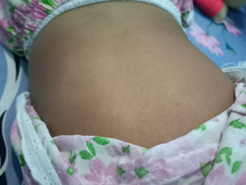 Ini kenapa ya bun , anak saya sperti ruam di kulit merah dan gatal seperti biang keringat