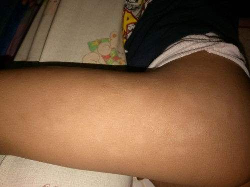 Kulit anakku (3,9 bulan) belang-belang putih)