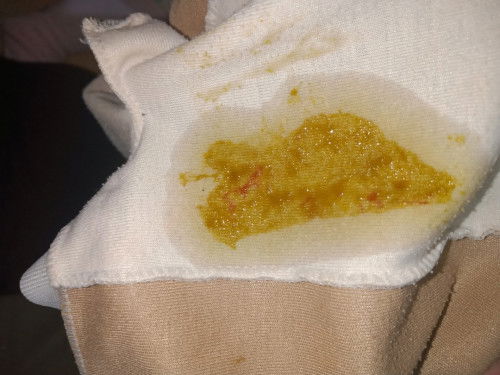 Anak diare dan bapil