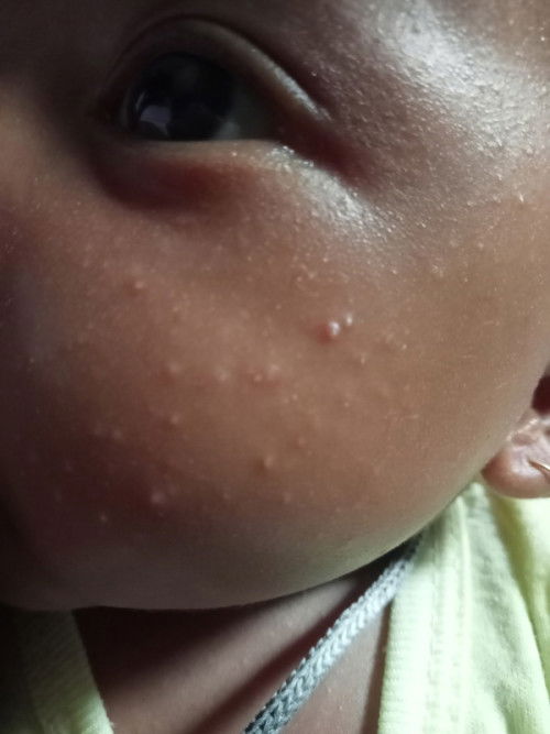 Bintik di pipi