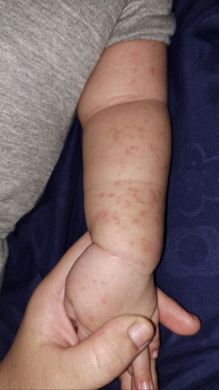 Bayi 4 Bulan Kulit Bintik-Bintik Merah