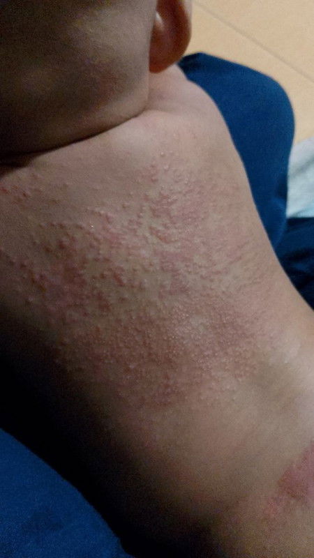 Merah merah di badan