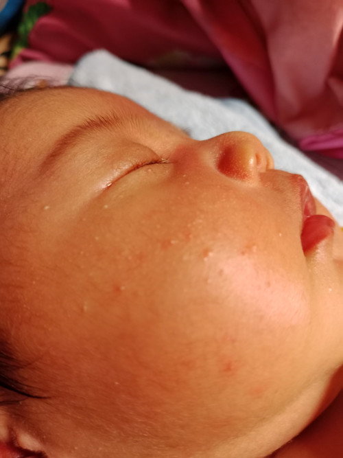 Bruntusan putih pada bayi
