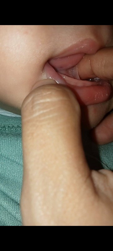 Lidah tongue tie