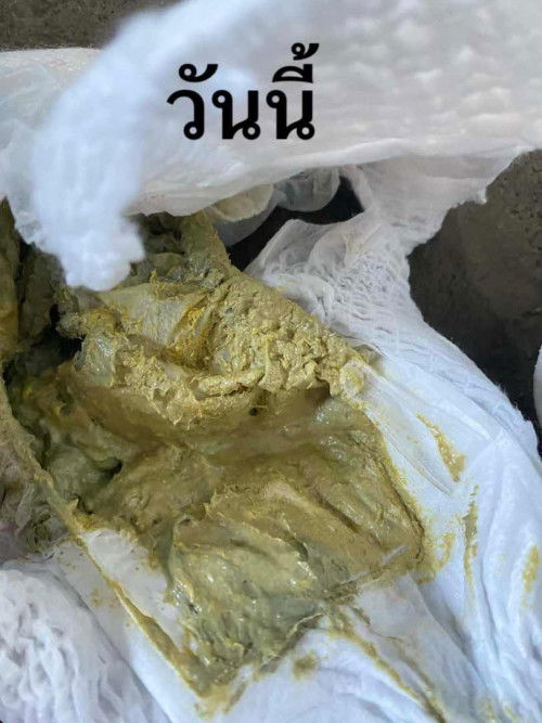 อึมีสีซีดค่อนเทา