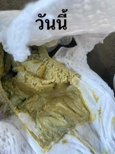 อึมีสีซีดค่อนเทา