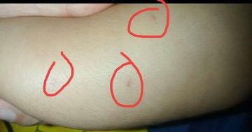 Bintik di kaki bayi pada usia 2 bulan 21 hari