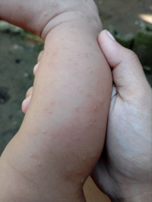 Allergic rash po ba to or what?