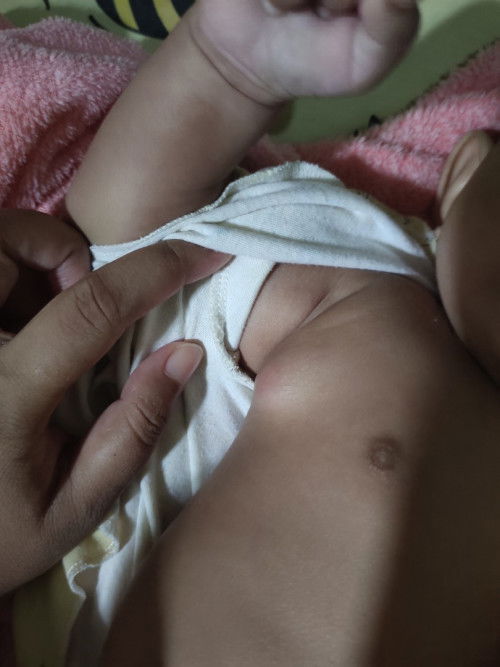 ada benjolan di samping ketiak